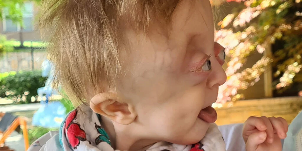 Hania kilkanaście dni po operacji w Dallas